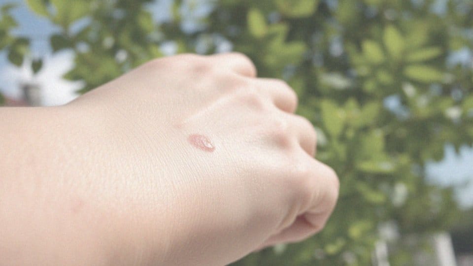 Jakie oparzenia powoduje promieniowanie UVB?